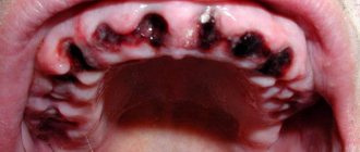 Сгусток крови после удаления зуба