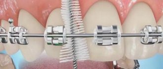 Brush for braces. We clean our teeth perfectly! 