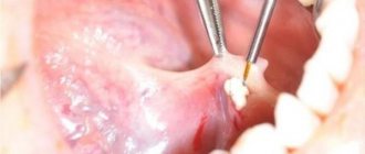 Sialendoscopy as a method for removing stones from the salivary gland