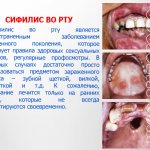 syphilis in the mouth photo