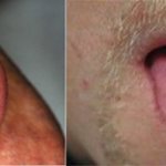 syphilis of the tongue in the primary period