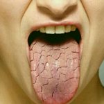 Severe dry mouth