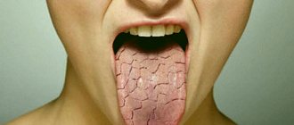 Severe dry mouth