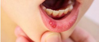 Symptoms and treatment of stomatitis in children