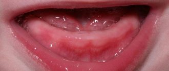 Симптомы прорезывания зубов
