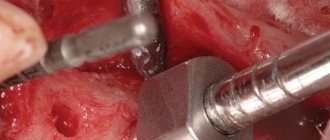 Sinus lift using osteotomy technique: possibilities for subsequent implantation