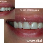 A chip on a front tooth was restored at Dial-Dent
