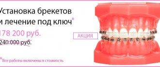 How much does it cost to install braces in Ulan Ude?