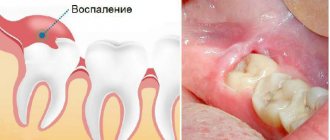 How long does it take for gums to heal after wisdom tooth removal?