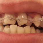 скученность зубов причины