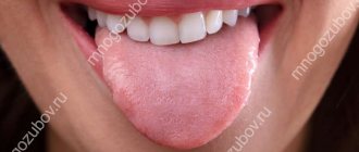 Teeth marks on the tongue