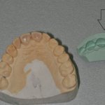 Impression of teeth