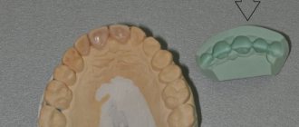 Impression of teeth