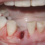 Condition of the gums after tooth extraction.jpg