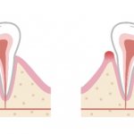 Condition of the gums with gingivitis
