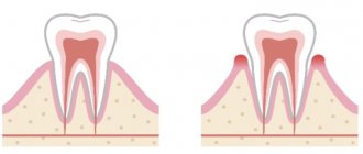 Condition of the gums with gingivitis