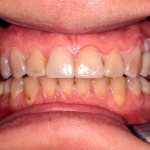 Способы имплантации 3 зубов подряд, сколько нужно имплантов - фото до лечения