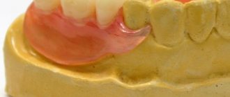 Timing and stages of manufacturing a removable denture