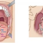 Stages of tongue cancer