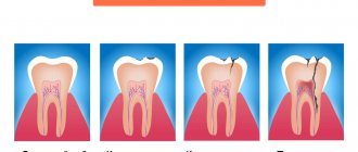 Stages of caries development in pictures