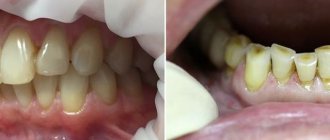 Стираемость зубов вследствие неправильного прикуса