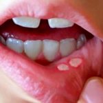 Stomatitis on the lip of a child