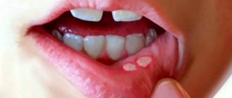 Stomatitis on the lip of a child