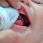 Стоматит у младенцев