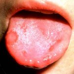Stomatitis in a child