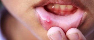 Stomatitis in a child