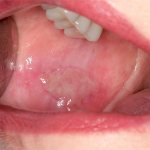 Stomatitis in adults