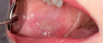 Stomatitis in adults
