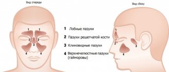 Subtotal darkening of the maxillary sinuses. What is it, how to treat with and without liquid, horizontal, vertical level 