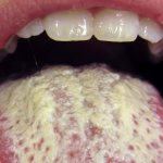 This is what a fungal infection on the tongue looks like