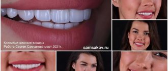 This is what women&#39;s Luxury veneers look like. The work of orthopedist Sergei Samsakov, March 2021 
