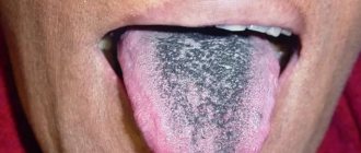 Dark coating on the tongue