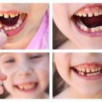Removing baby teeth does not cause severe pain
