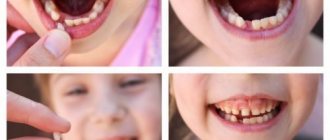 Removing baby teeth does not cause severe pain
