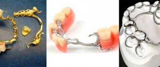 caring for clasp dentures