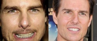 Tom Cruise smile, teeth fixed with braces