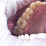 installing a filling on a tooth price