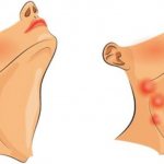 Enlarged lymph nodes