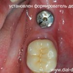 a gum former is screwed into the implant