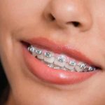 at what age is it better to get braces?