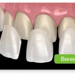 options for restoring a damaged tooth