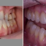 view of teeth before and after complex treatment with implantation and prosthetics