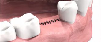 виды швов стоматология