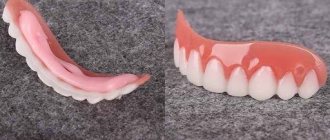 Veneers Perfect Smile (Perfect Smile Veneers). Real reviews, instructions on how to install 