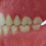 The effect of occlusion on the healing of periodontal lesions