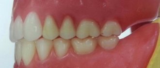 The effect of occlusion on the healing of periodontal lesions
